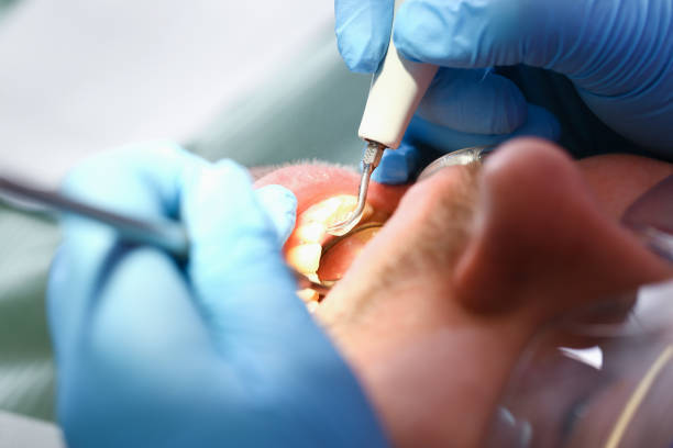 Best Knocked-Out Tooth (Avulsed Tooth) Treatment in Valley Forge, TN